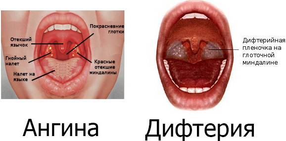 Состояние горла при различных заболеваниях Дифтерия и ангина