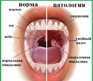 Больное и здоровое горло