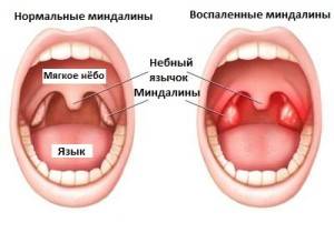 Симптомы гнойной ангины