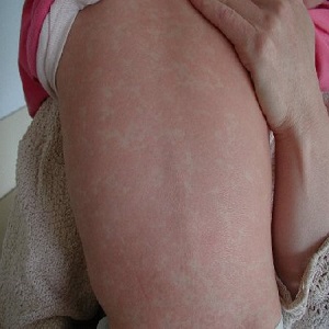 Аллергическая реакция в виде крапивницы после вакцинации Аллергическая реакция в виде крапивницы после вакцинации