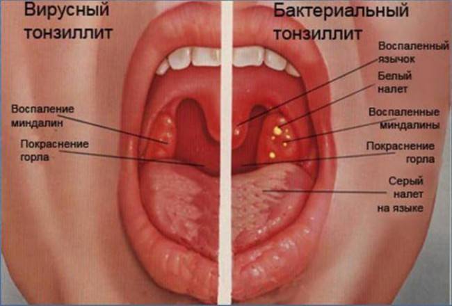 Клиника заболевания Формы тонзиллита