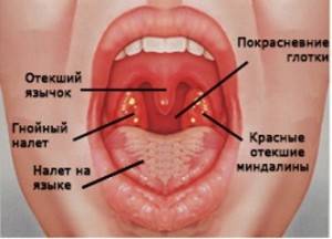 Симптомы тонзиллита Симптомы тонзиллита