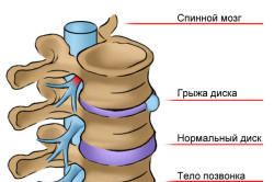 Межпозвоночная грыжа как причина защемления нерва