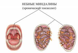 Тонзиллит горла