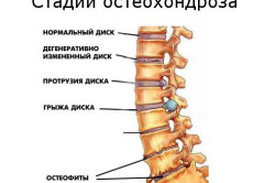 Стадии остеохондроза Стадии остеохондроза