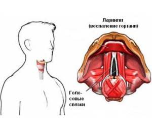 Основные симптомы ларингита