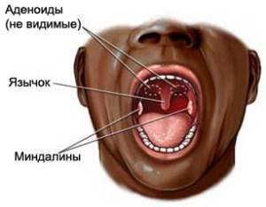 Симптомы ангины