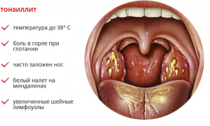 Тонзиллит горла