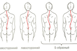 Виды сколиоза