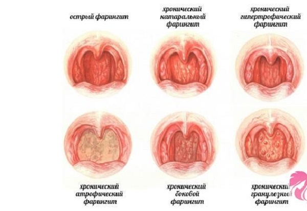Виды фарингита 