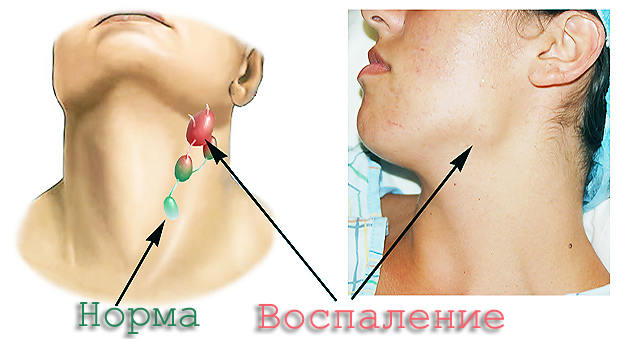 Разница между больным и здоровым лимфоузлом Как выглядит воспаленный лимфоузел